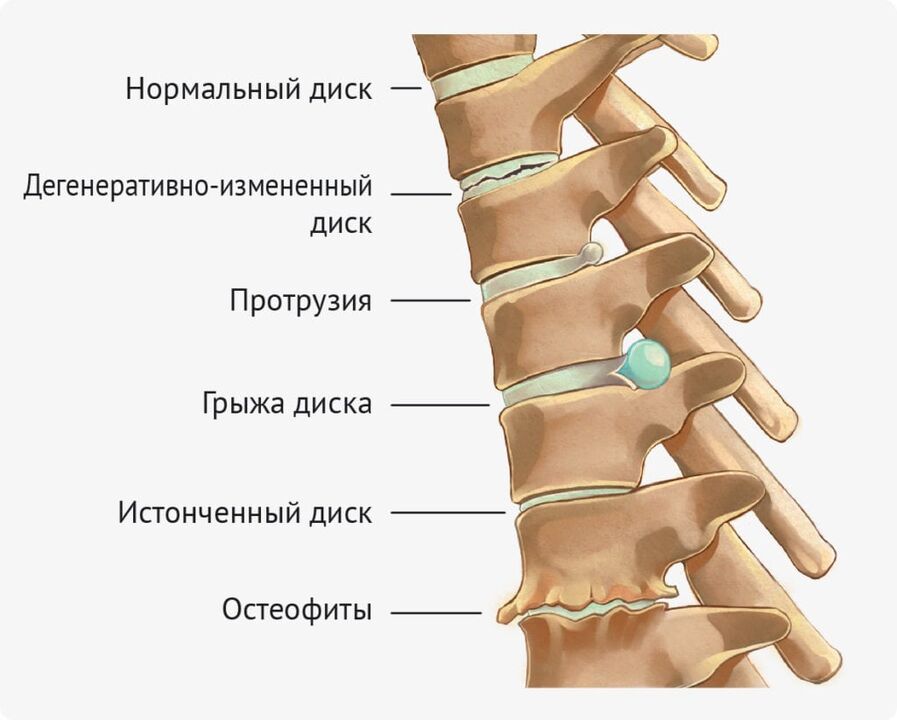Disc deformation for lumbar osteoarthritis