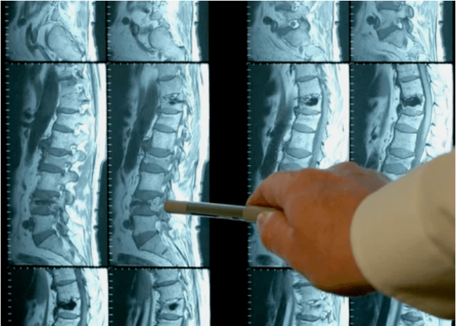 Osteoarthritis diseases in the spine