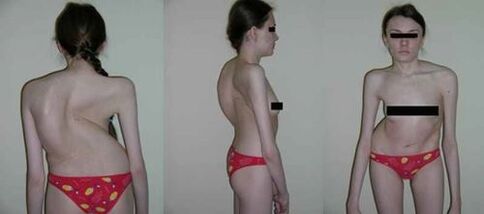 The curvature of the spine is as a result of osteoarthritis