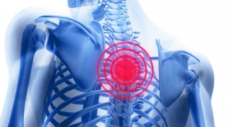 Back pain can be caused by a herniated disc