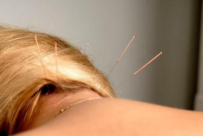 Acupuncture treats osteoarthritis