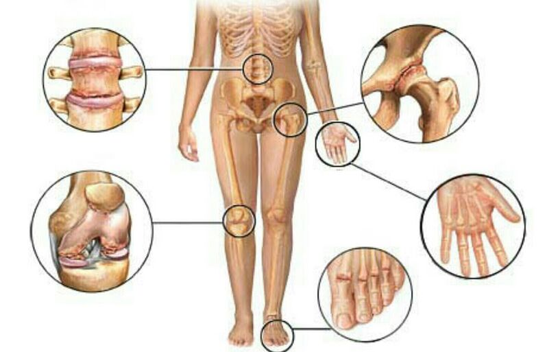 Types and degrees of joint disease
