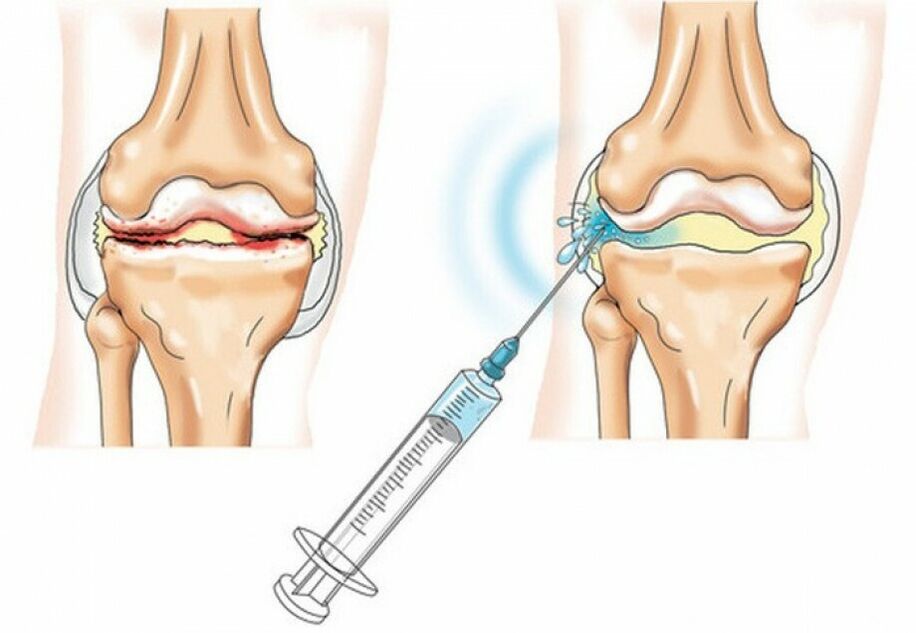 injection into the knee joint with arthritis