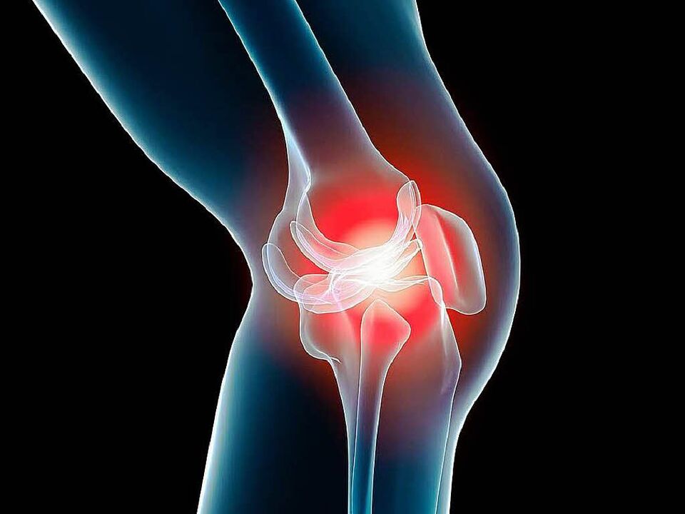 knee arthritis