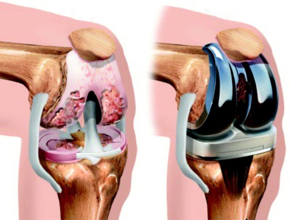In cases where the knee joint is completely damaged due to osteoarthritis, it can be restored with arthroscopy