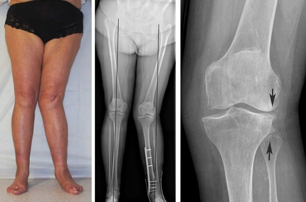 Severe arthritis may be clearly visible even without X-rays