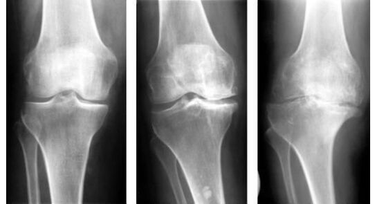 The mandatory diagnostic measure when determining knee osteoarthritis is X-ray